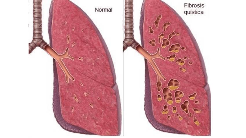 La terapia triple proporciona beneficios robustos y duraderos en la fibrosis quística