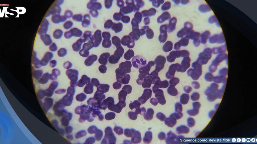 Seis meses de cansancio ocultaban una anemia asociada a enfermedad renal crónica