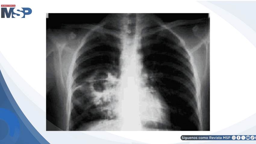 Tuberculosis pulmonar: hallazgos clínicos, microbiológicos y radiológicos en paciente de 38 años