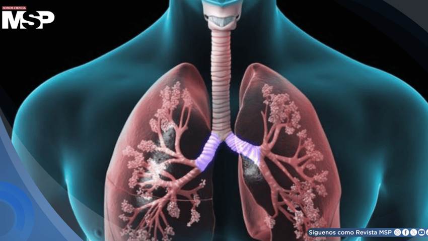 ¿Cómo reconocer la hipertensión pulmonar? Causas y tratamientos que pueden cambiar su pronóstico