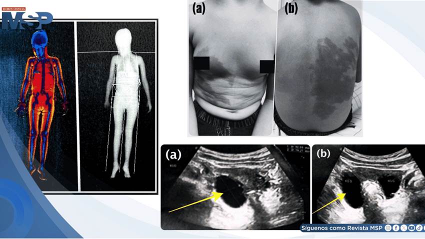 Niña de 3 años con sangrado vaginal y desarrollo mamario resulta con síndrome de McCune-Albright