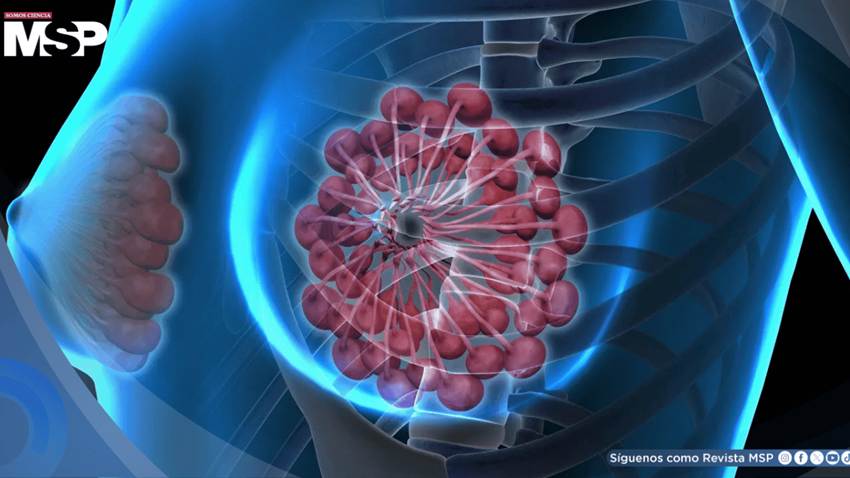Cáncer de mama crecerá 34% en el 2050 y podría causar 1,4 millones de muertes al año: Estudio