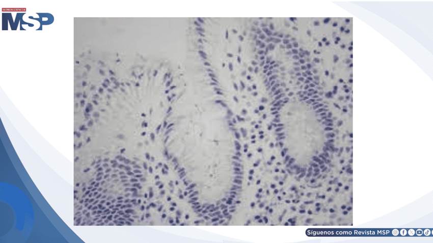 Helicobacter pylori: infección causa gastritis crónica y úlcera duodenal en paciente de 46 años