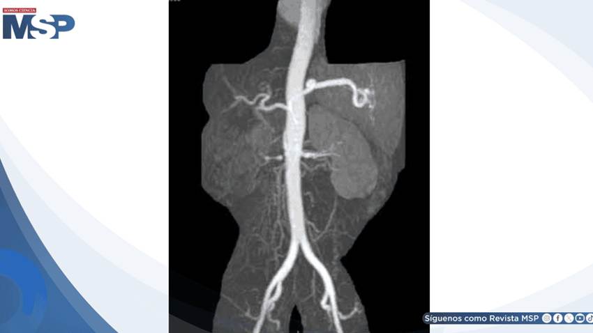 Hipertensión renovascular por estenosis de la arteria renal: causa detrás de una crisis hipertensiva