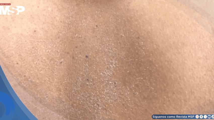 Picazón intensa nocturna, resequedad y lesiones cutáneas recurrentes revelan dermatitis atópica moderada