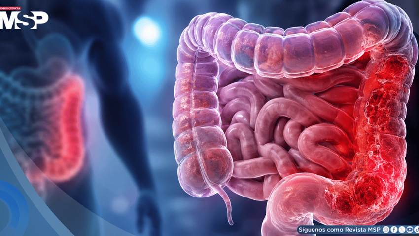 Colitis Ulcerosa: Tofacitinib mostró el beneficio clínico más duradero tras fracaso de terapias anti-TNF