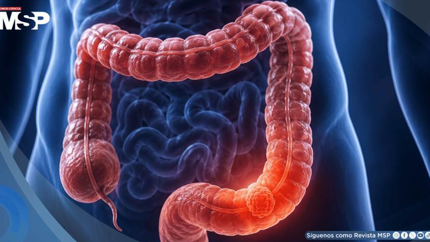 Cáncer colorrectal en menores de 50 años: aumenta el tamizaje, pero persisten las desigualdades