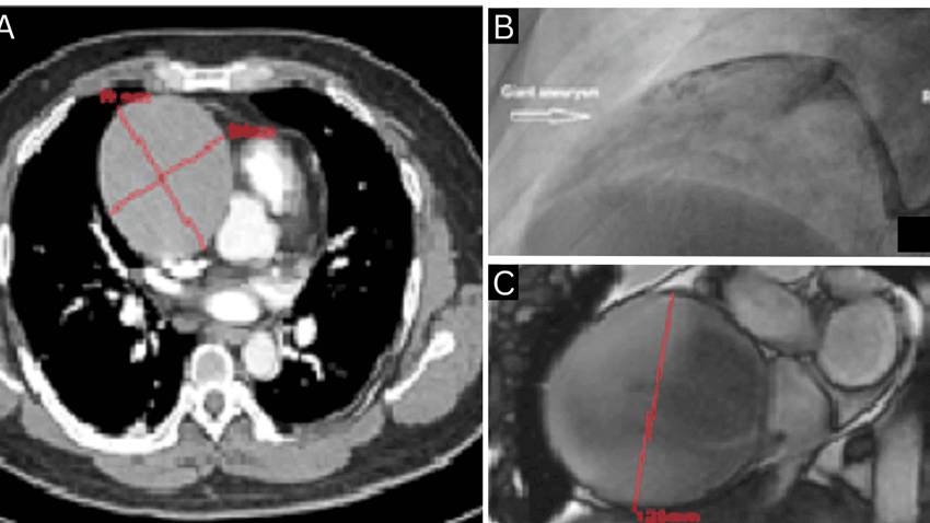 Hombre de 40 años presenta aneurisma gigante de arteria coronaria derecha asociado a consumo de drogas