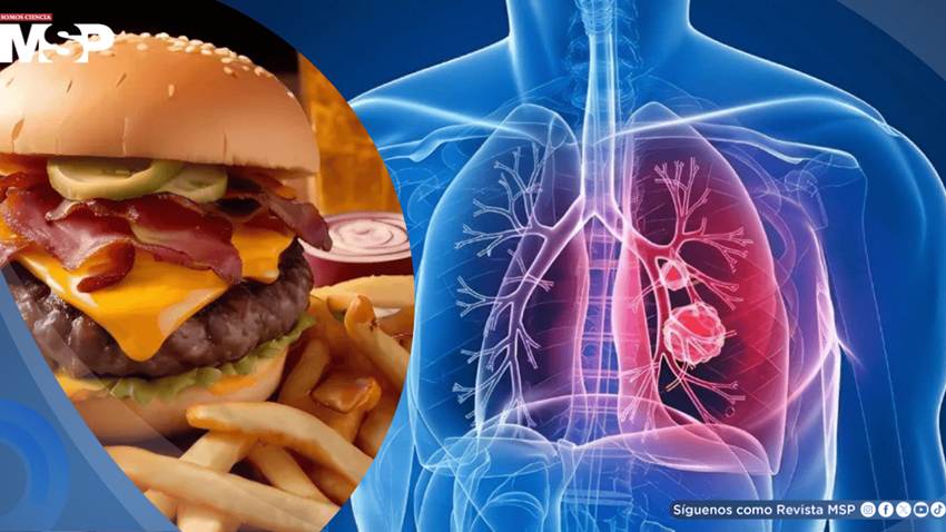 Consumo elevado de ultraprocesados se asocia con mayor riesgo de cáncer de pulmón, según estudio