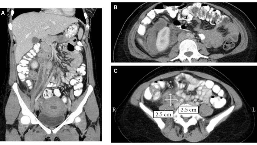 Dolor pélvico y masa abdominal palpable como presentación de trombosis venosa ovárica tras el parto