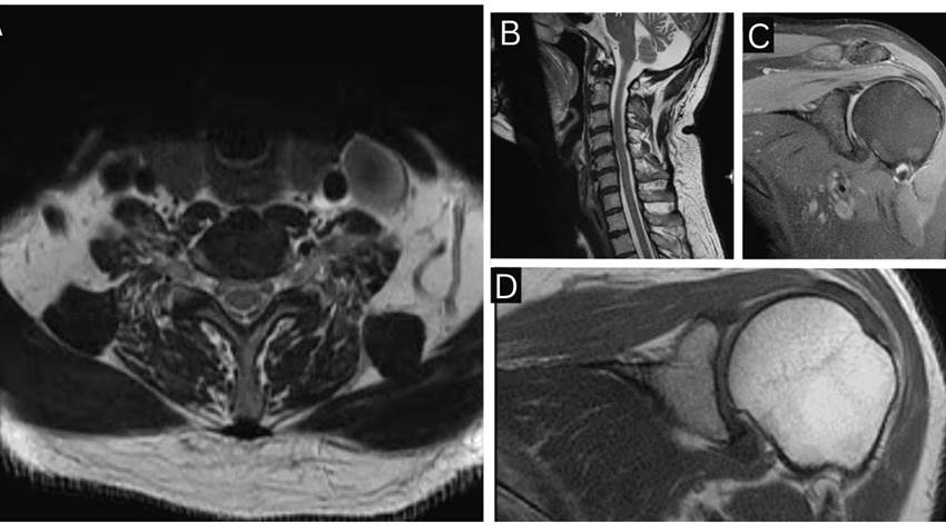 Neuritis braquial diagnosticada en hombre de 50 años tras dolor y pérdida de fuerza en hombro izquierdo