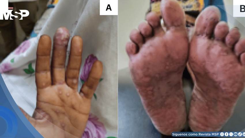 Reportan primer caso de coinfección por Mpox y VIH avanzado con lesiones pustulares y úlceras vulvares