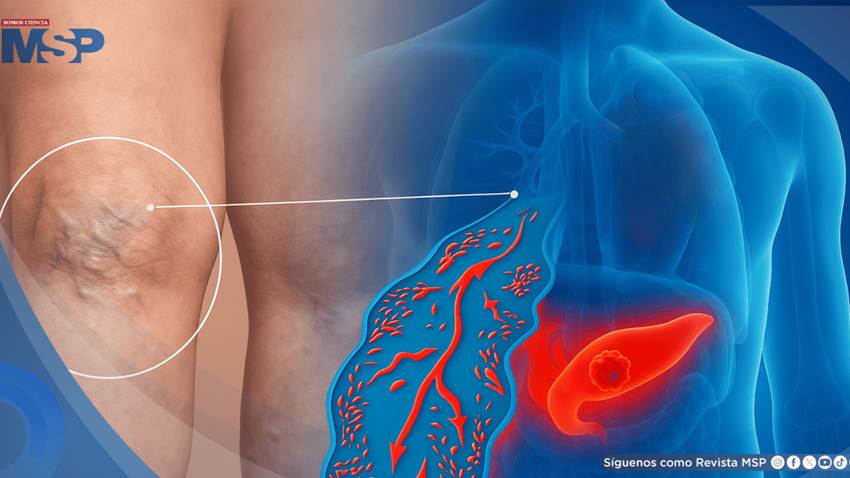 ¿Coágulo doloroso en la pierna? Podría ser la primera señal de cáncer de páncreas