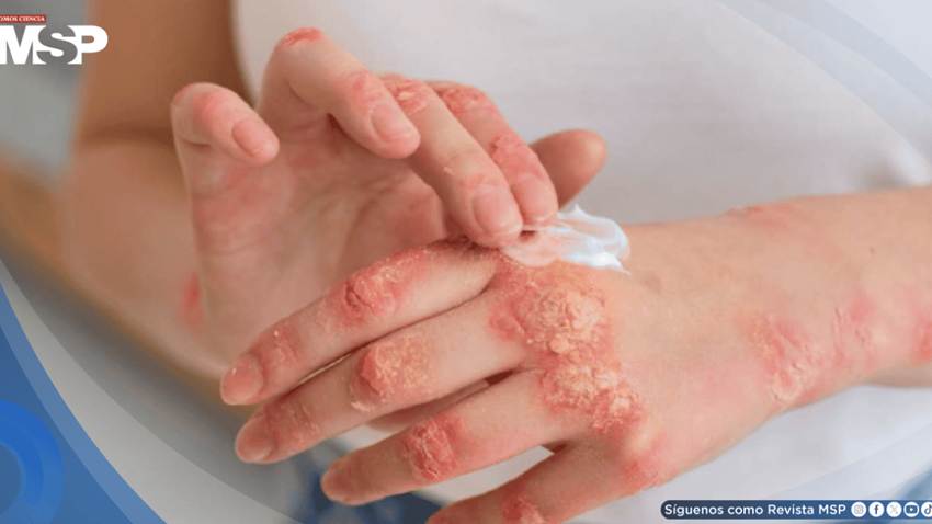 Nuevos tratamientos biológicos para la psoriasis logran 90% de efectividad y previenen daños articulares