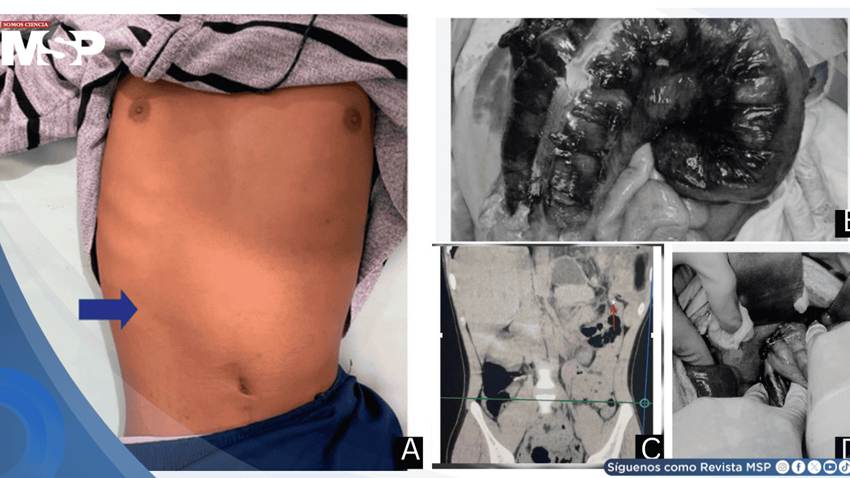 Detectan hernia diafragmática que ocasionaba obstrucción intestinal en paciente de 18 años