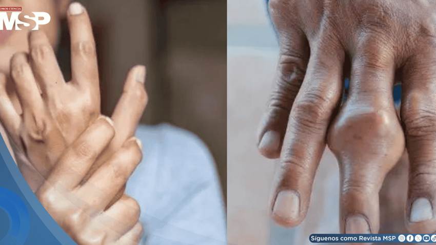 Rigidez matutina y dolor articular progresivo revelan artritis reumatoide activa en mujer de mediana edad