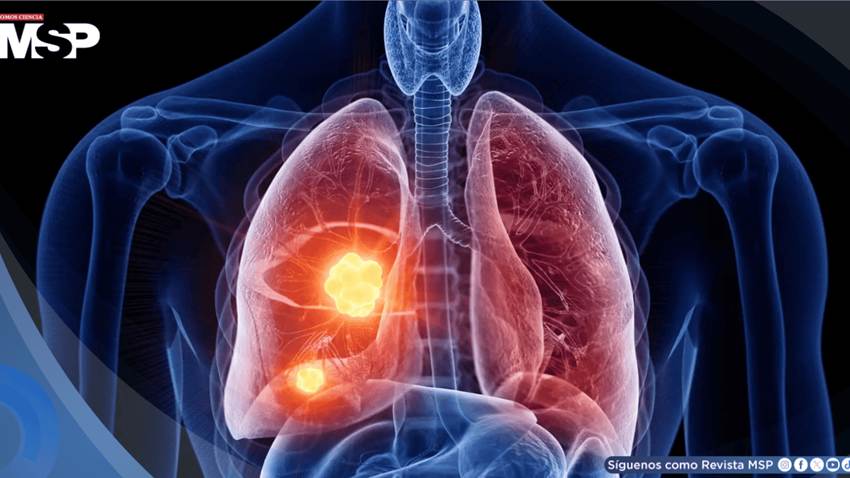 Desarrollan sensor óptico que detecta cáncer de pulmón en sangre antes que los estudios de imagen