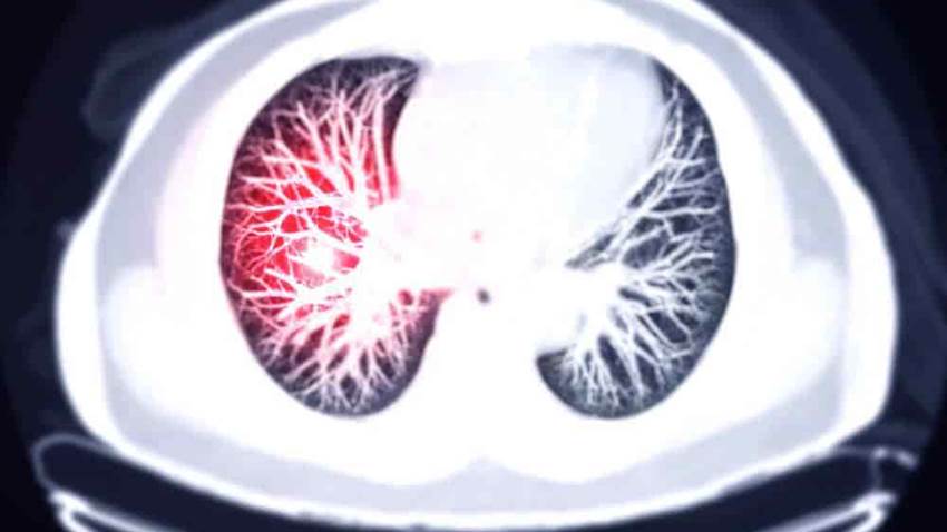 Método diagnóstico para tromboembolia pulmonar reduce la necesidad de estudios de imagen