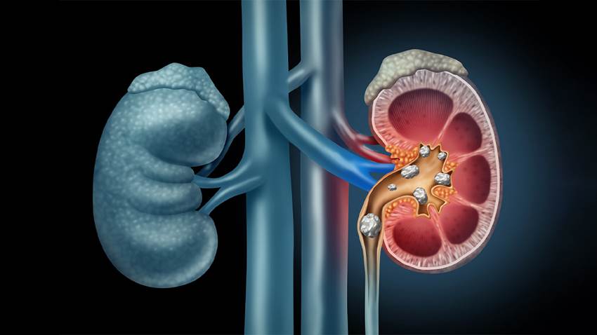 Cuáles son los tipos de cálculos en el riñón y qué puedes hacer para prevenirlos