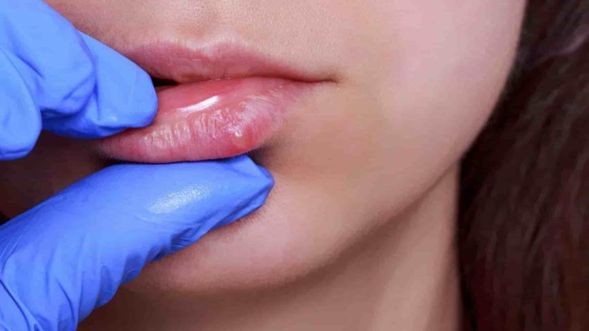 Causas del herpes labial y cómo prevenir su aparición