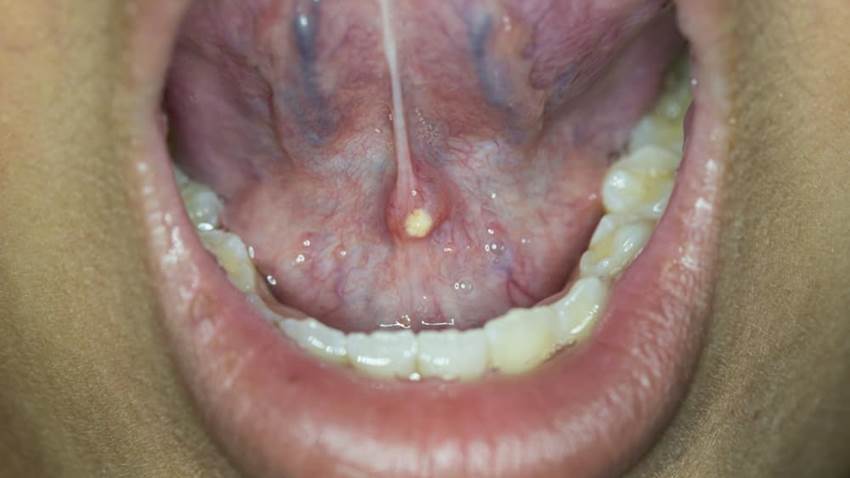 ¿Sialoendoscopia o botox?: Tratamientos actualizados y efectivos para el manejo de tumores salivales