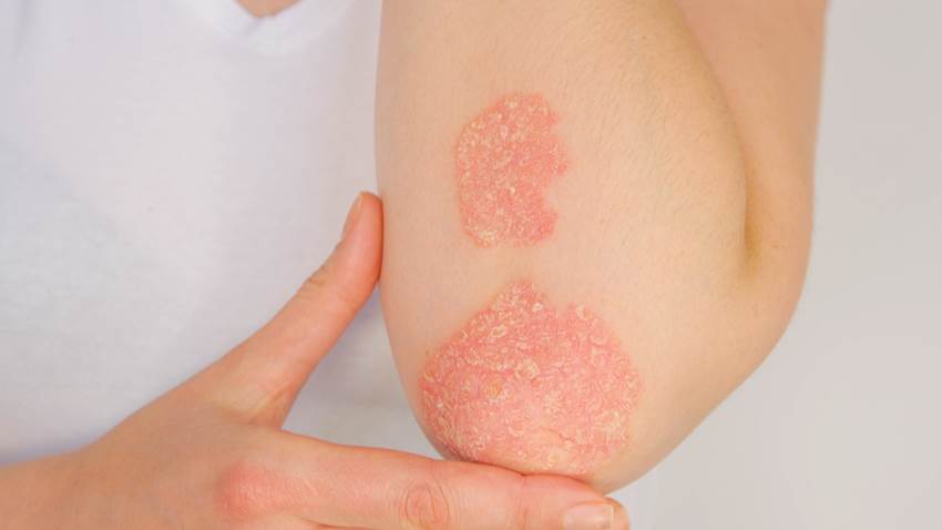 Vacunas de RNA mensajero serían seguras para pacientes con psoriasis, según dermatólogos