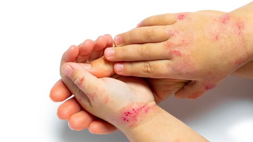 FDA aprueba upadacitinib para tratar a adultos y niños de 12 años o más con dermatitis atópica